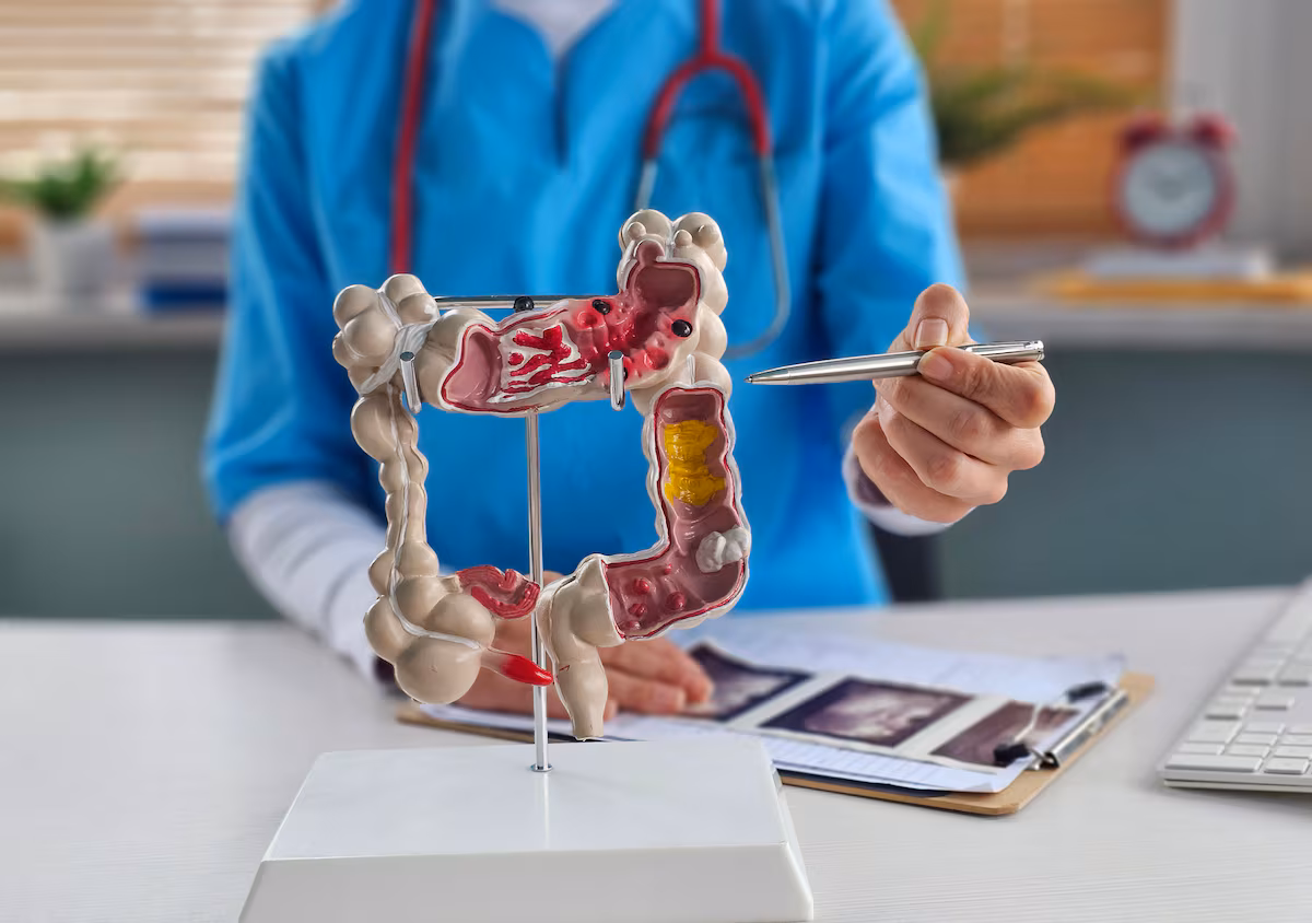 Paraná tem 7 casos de câncer de intestino por dia; aumenta casos em jovens