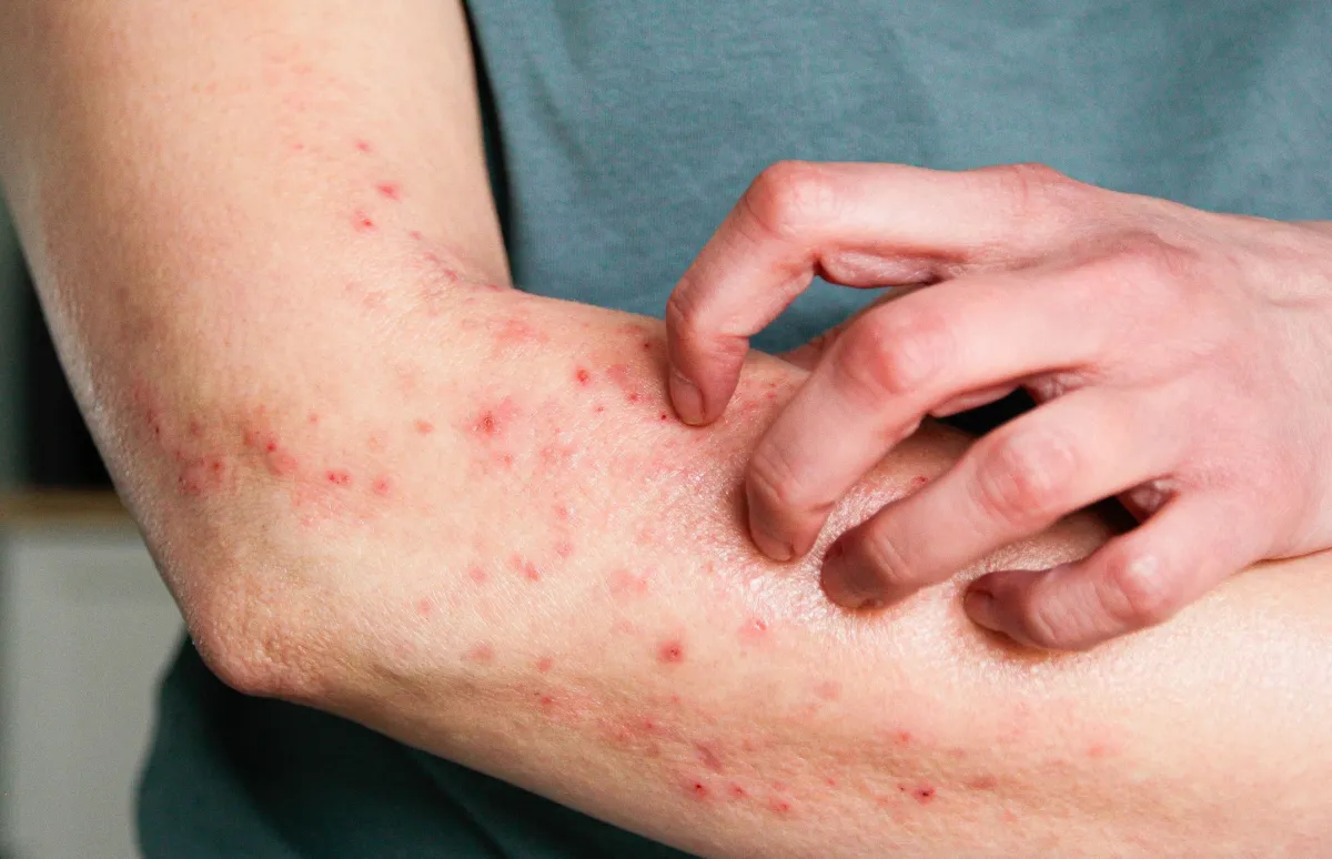 Paraná registra primeiro caso de Mpox no estado em 2026; especialista aponta que doença não é motivo para histeria coletiva
